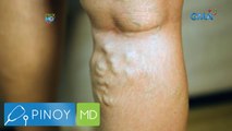 Ano nga ba ang solusyon sa varicose veins? | Pinoy MD