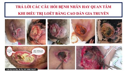 Bs Tuy trả lời những câu hỏi bệnh nhân quan tâm khi sử dụng Cao dán gia truyền
