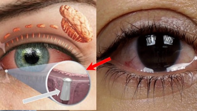 आंखों से पानी क्यों गिरता है Entropion से लेकर Blepharitis का Symptom, Doctors Advice | Boldsky