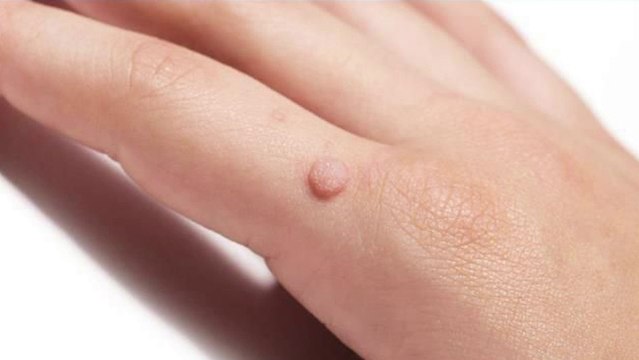 bd-tumores-benignos-de-piel-180423