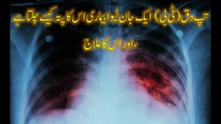 TB ka ilaj,Tuberculosis (TB) is a life-threatening disease, how it is diagnosed, and its treatment