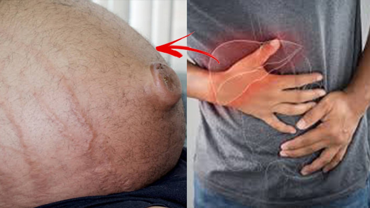 Liver में पानी क्यों भरता है । Ascites क्या है...