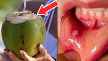 Coconut Water से Mouth Ulcer कैसे ठीक करें | Muh Ke Chale Nariyal Pani Se Kaise Thik Kare | Boldsky