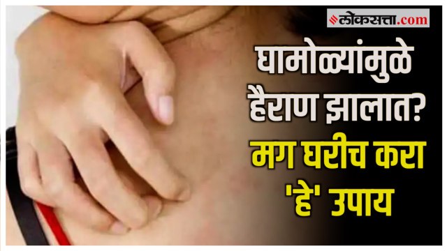 Summer Tips : घामोळ्यांमुळे होणार त्रास कमी करण्यासाठी 'हे' घरगुती उपाय ठरतील फायदेशीर