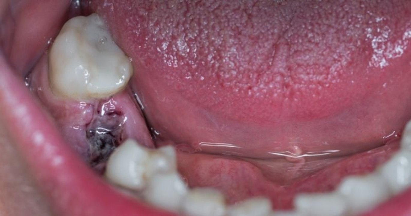 Vivant dans un désert médical dépourvu de dentiste, il prend une pince et s'arrache une dent