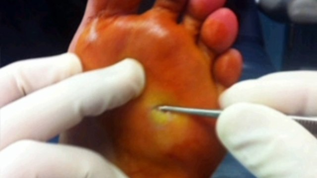 5 ways to remove warts or skin tags