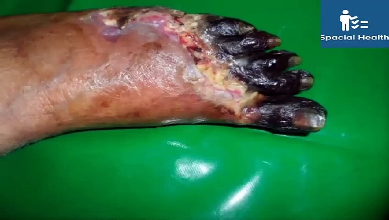 Gangrene Ka Ilaj Gangrene Ka Ilaj Gangrene Treatment With Chitosan Capsule Urdu Hindi