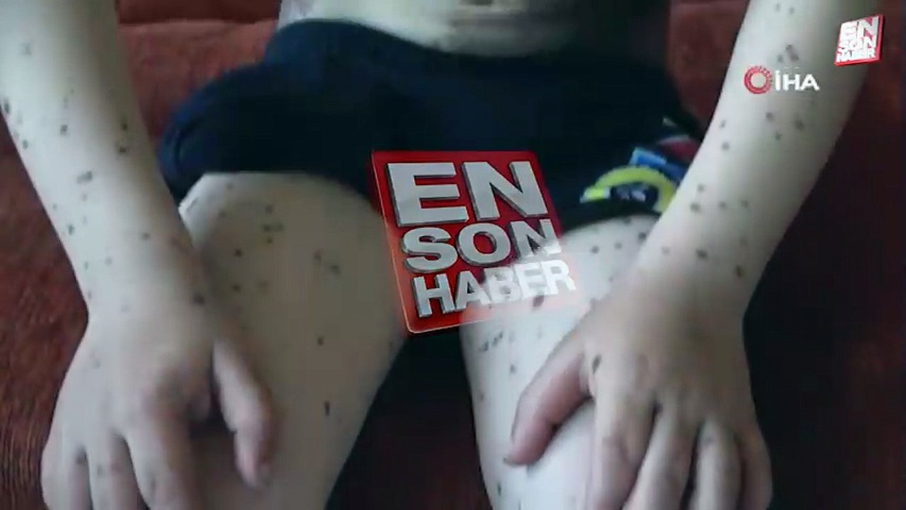 Bitlis'te küçük çocuğun vücudunu dev benler sardı: Tedavi olmak istiyor