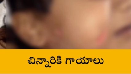 రంగారెడ్డి: వీధి కుక్కల దాడిలో చిన్నారికి గాయాలు