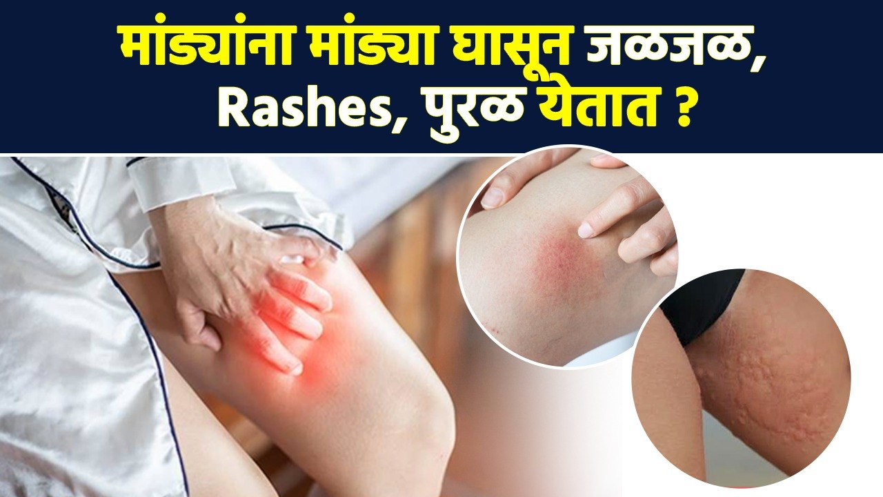 मांड्यांना मांड्या घासून त्रास होतो? हा उपाय करा |  How to Get Rid of Itchy Thighs |Itchy Thighs MA2