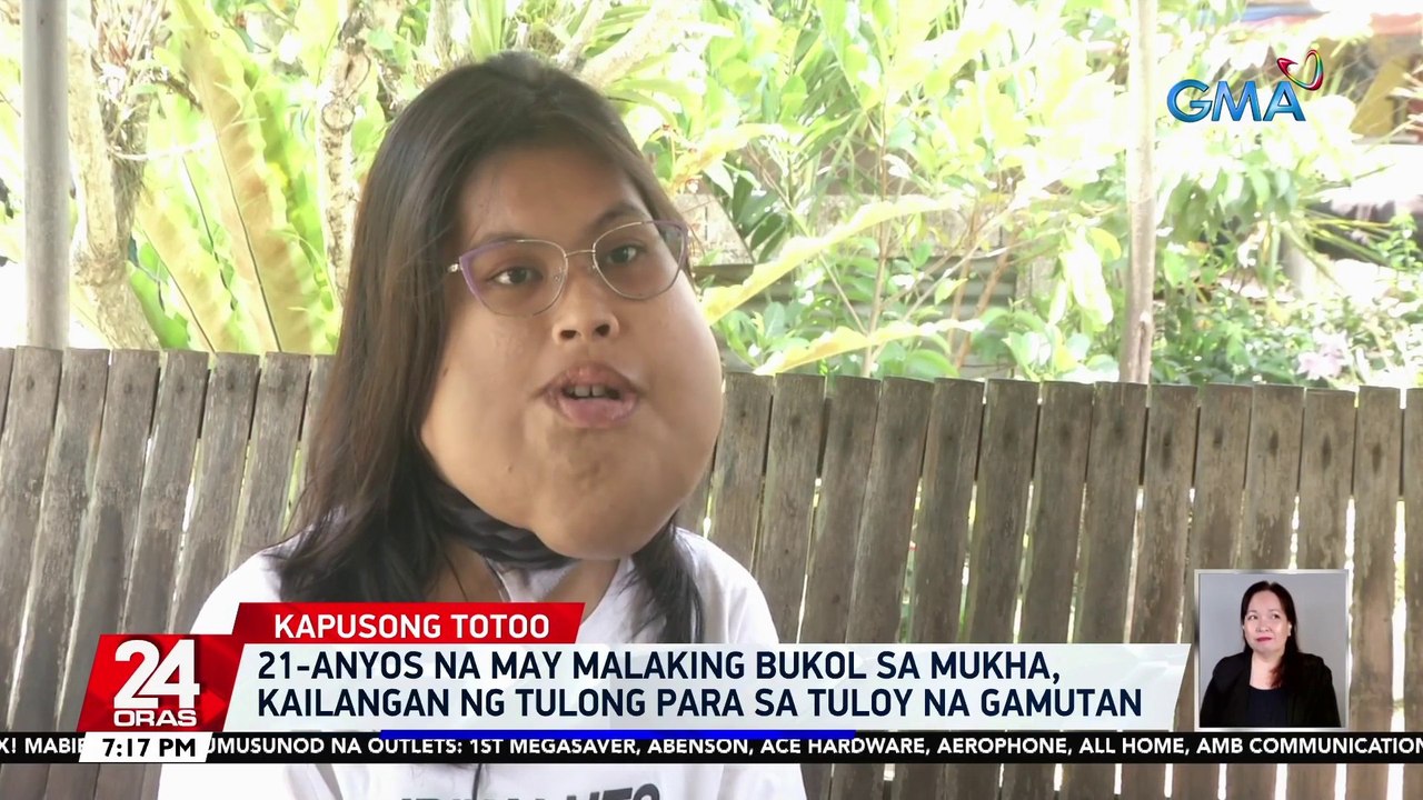 21-anyos na may malaking bukol sa mukha, kailangan ng tulong para sa tuloy na gamutan | 24 Oras
