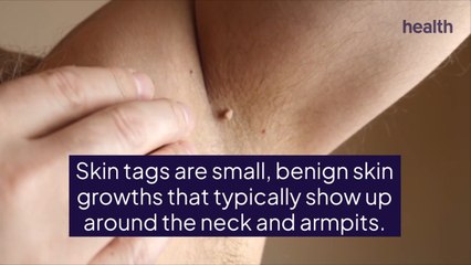 Skin Tags Vs. Moles—How to Tell the Difference