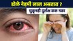 Red Eyes Cause | डोळे लाल होण्याची ही कारणं | How to Treat Red Eyes | Eye Infection | RI3