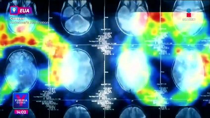 ¡Por primera vez! Un fármaco que combate el Alzheimer