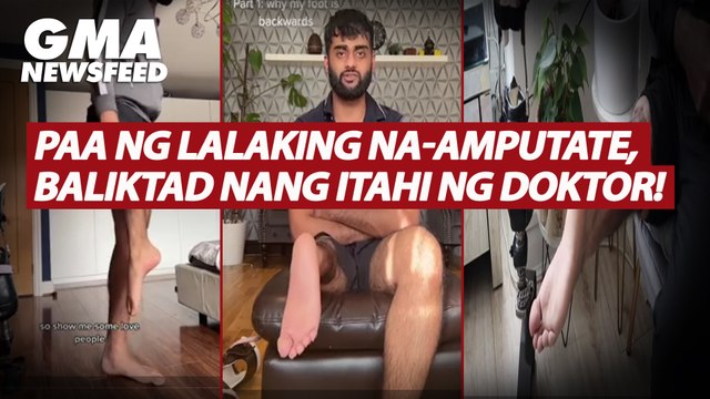 Paa ng lalaking na-amputate, baliktad nang itahi ng doktor! | GMA News Feed