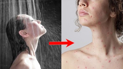 च‍िकनपॉक्‍स में नहाना चाहिए या नहीं | Chickenpox Me Nahana Chahiye Ya Nahi | Booldsky