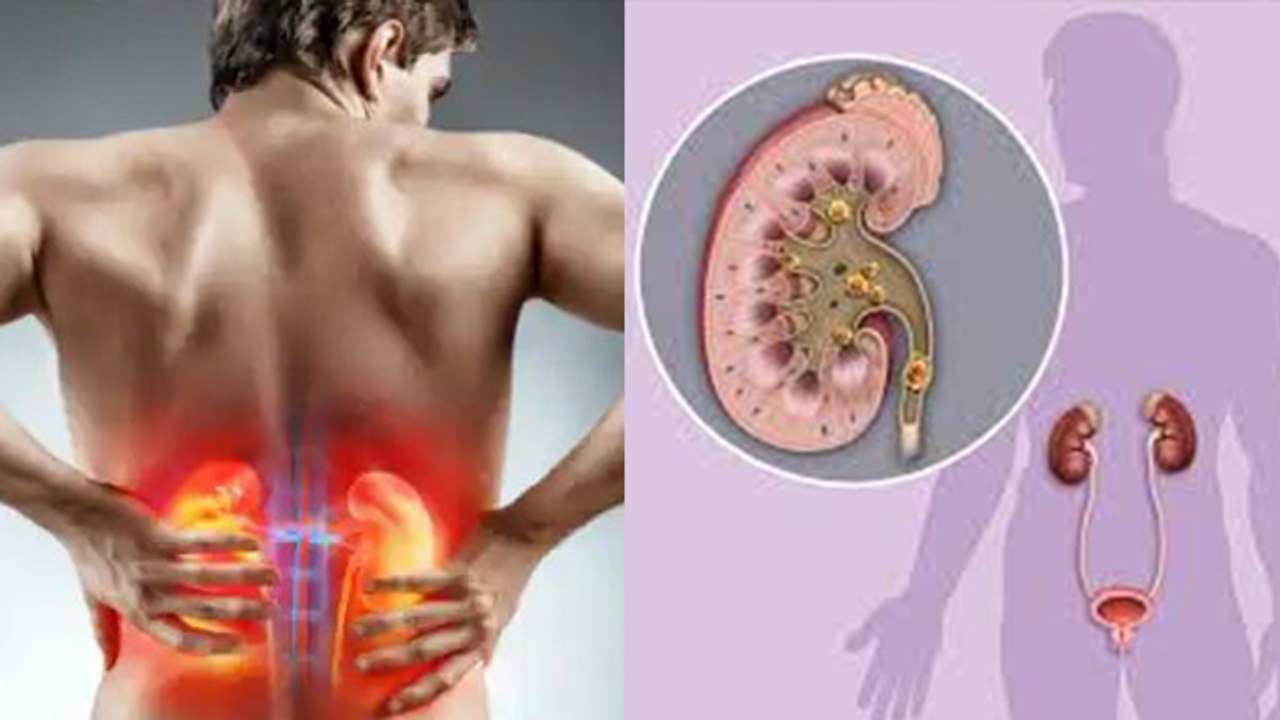 पुरुषों को किडनी में पथरी ज्यादा क्यों होती है। Pursho Ko Kidney Me Stone Jyada Kyu Hota Hai।Boldsky