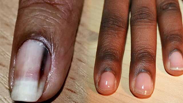 नाखून के आसपास की त्वचा काली क्यों पड़ती है | Nails Ke Aaspas Skin Par Kalapan Kyu Hota Hai |Boldsky