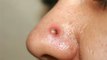 Basal Cell Carcinoma क्या होता है । Nose पर Pimple से Cancer Reason, Symptoms । Boldsky