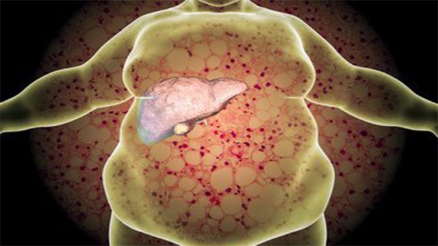 लिवर में गर्मी के लक्षण | लिवर में गर्मी का कारण | Liver Me Garmi Ho To Kya Kare | Boldsky