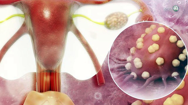 Se diagnostica de manera tardía casos de cáncer de ovario en México, advierten especialistas