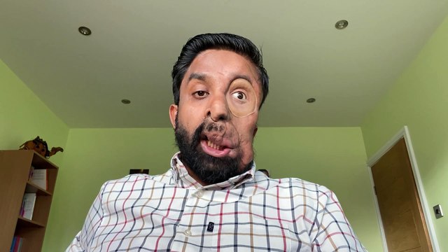 Man with facial disfiguration left disheartened after AI facial recognition software failed to recognise him