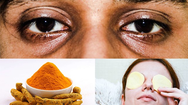 Dark Circles पर आलू का रस और हल्दी लगाने के होगे ये जबरदस्त फायदे । Boldsky