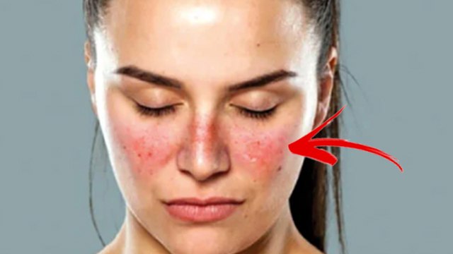 ल्यूपस रोग क्या है | ल्यूपस के लक्षण क्या है | Lupus Kya Hota Hai | Lupus Symptoms | Boldsky