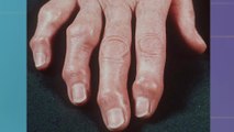 bd-deformidades-en-manos-por-enfermedades-reumaticas-100523