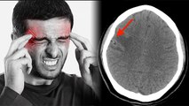 सिर दर्द होना दिमाग में कीड़े के लक्षण | Neurocysticercosis Kya Hai | Boldsky