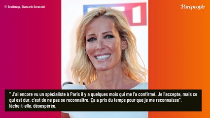 Ophélie Winter défigurée à coups de barre de fer : "J'ai perdu mon nez pendant cette agression"
