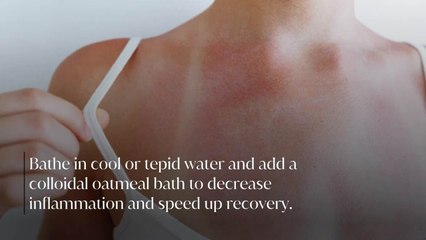 How to Get Rid of a Sunburn Quickly