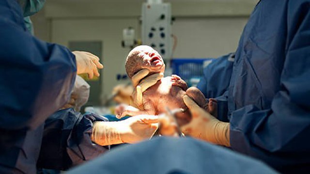 Cesarean Delivery Ke Side Effects । C-Section Delivery Ke Side Effects । Boldsky