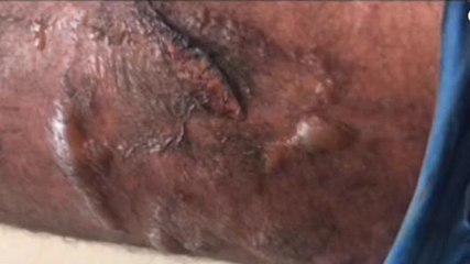 जबलपुर: जेब में रखे मोबाइल में हुआ ब्लास्ट, युवक घायल