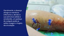 Dicas para prevenir trombose