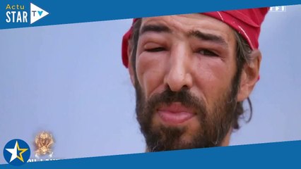 Esteban (Koh-Lanta) ne sait pas s'il a fait une allergie à l'oeil : "Je n’ai aucune idée de ce qu’il