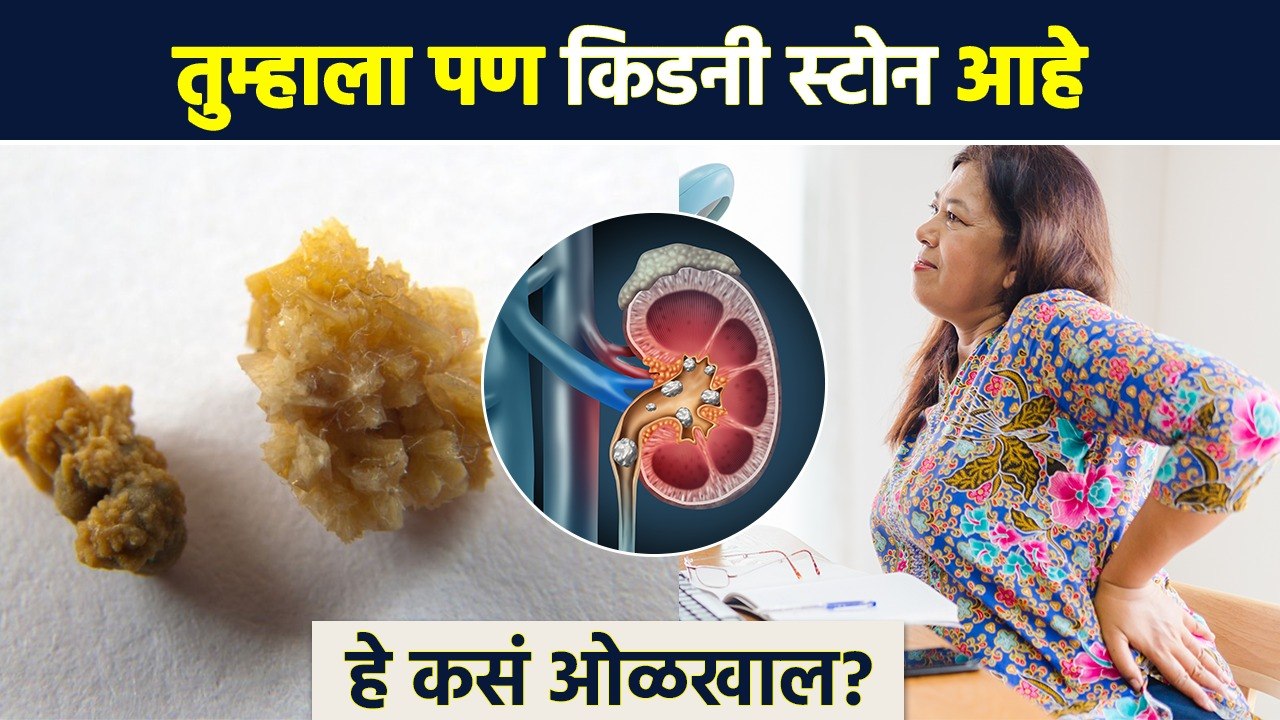 किडनी स्टोन झालाय हे कसे ओळखाल? | How to Identify Kidney Stones | Kidney Stones Symptoms | AI2