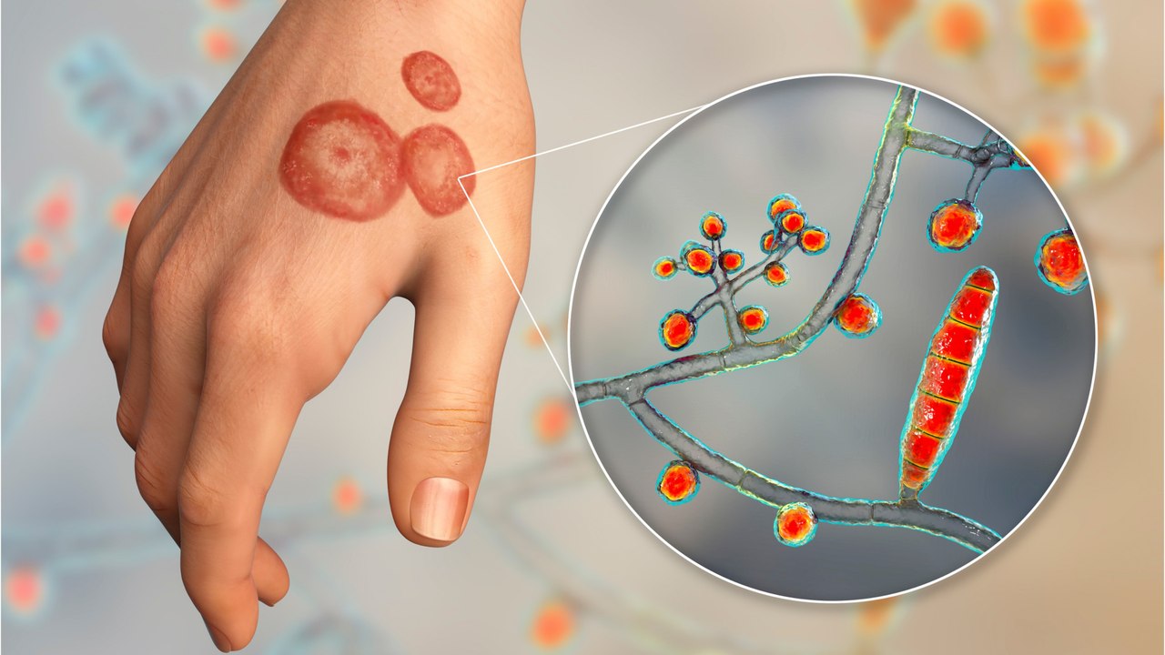 Expert warns of 'slowly evolving epidemic' of skin infections, should we be worried?
