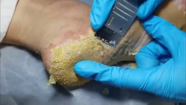 Podiatry _ Skin peeling from feet. Dead skin removal & Cracked heels treatment. Dry skin treatment.