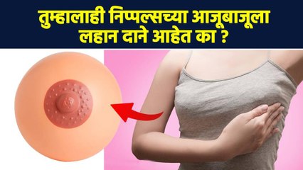 निप्पल्सवर का असतात लहान-लहान दाने? Why do we have Small Bumps on Nipples? |Pimple on the Nipple RI2