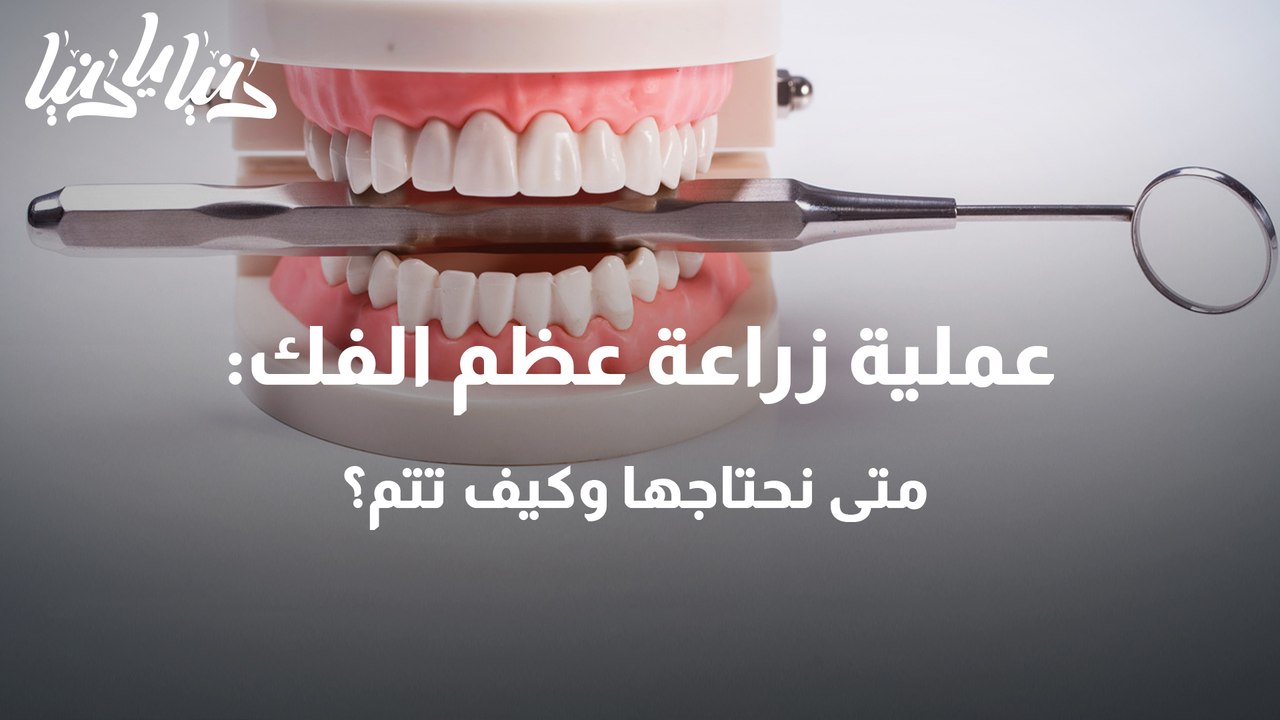 عملية زراعة عظم الفك متى نحتاجها وكيف تتم؟