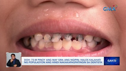 73-M Pinoy ang may sira ang ngipin; halos kalahati ng populasyon ang hindi nakakapagpatingin sa dentista — DOH | Saksi