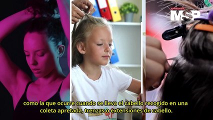 Cinco tipos de alopecia - #ExclusivoMSP
