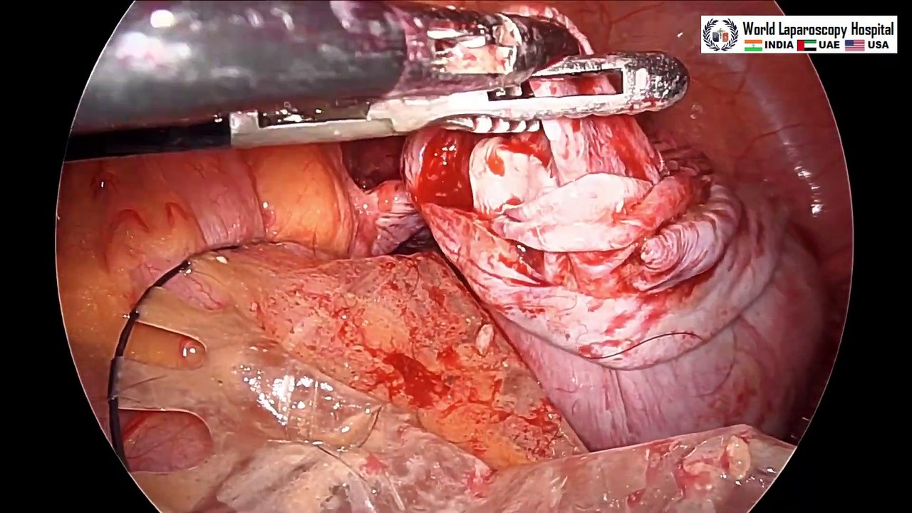 Bilateral Ovarian Dermoid Dermoid Cyst