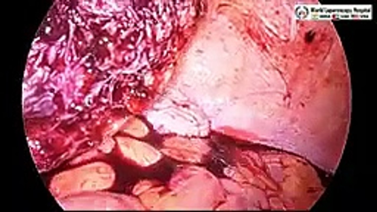 20 CM Large Intramural Fibroid's Laparoscopic Myomectomy