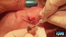 Las mejores extracciones de la Dra Pimple Popper