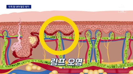 두피 땀 내고 밤 시간대 푹 자야 ‘탈모’ 막는다
