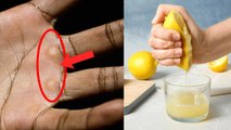 Hand Foot Corn Home Remedy: तलवे हाथ पर बनी गांठ को बिना दर्द निकालने का देसी इलाज | Boldsky