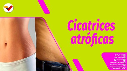 Buena Vibra | ¿Qué son las estrías y por qué surgen?