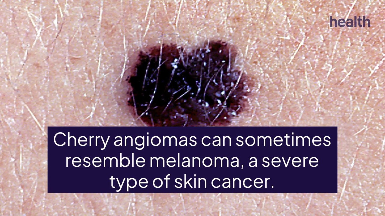 What Are Cherry Angiomas? video Dailymotion